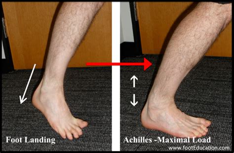 achilles tear test standing on toes|complete rupture of achilles tendon.